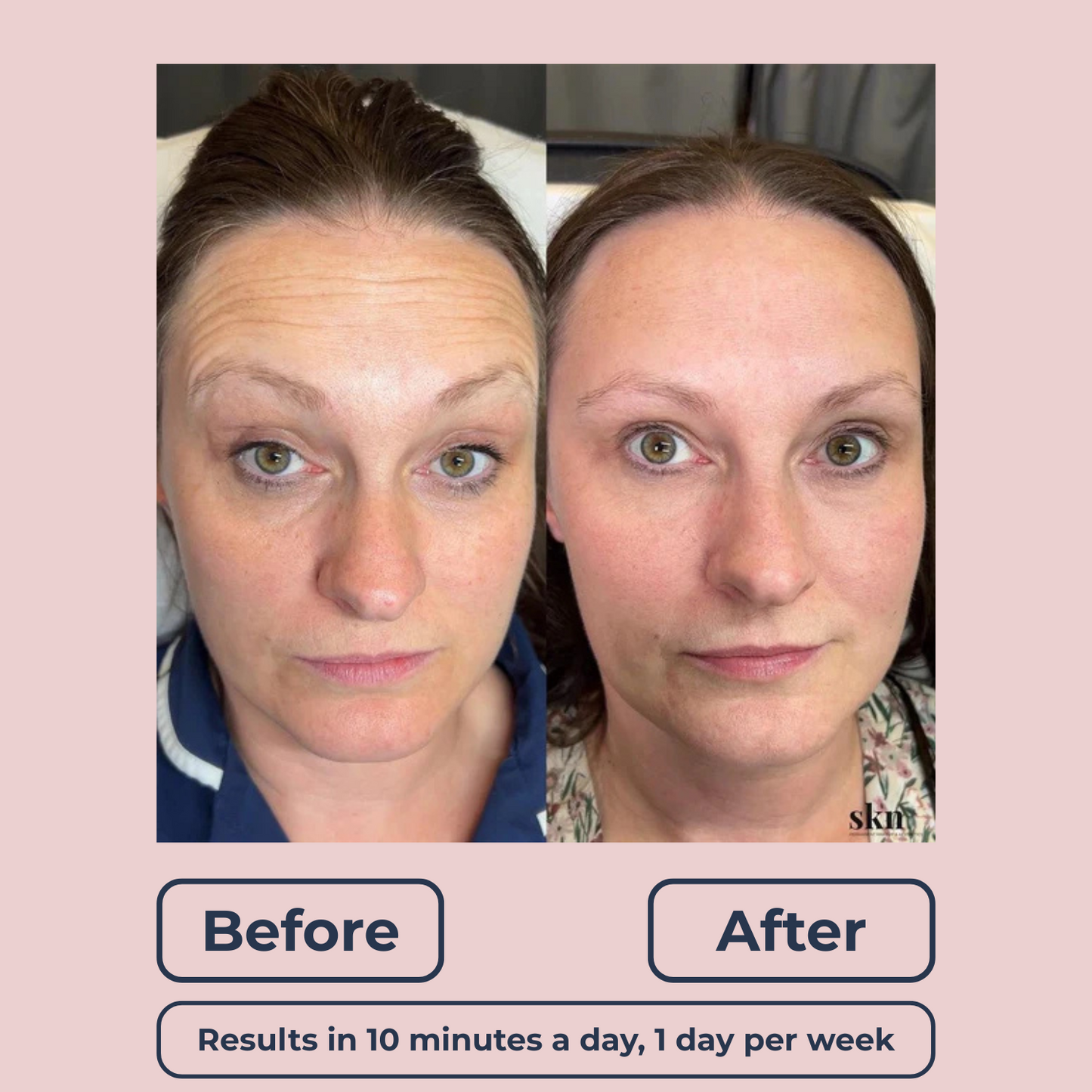 Lutique™ Original 6in1 FaceSculpt