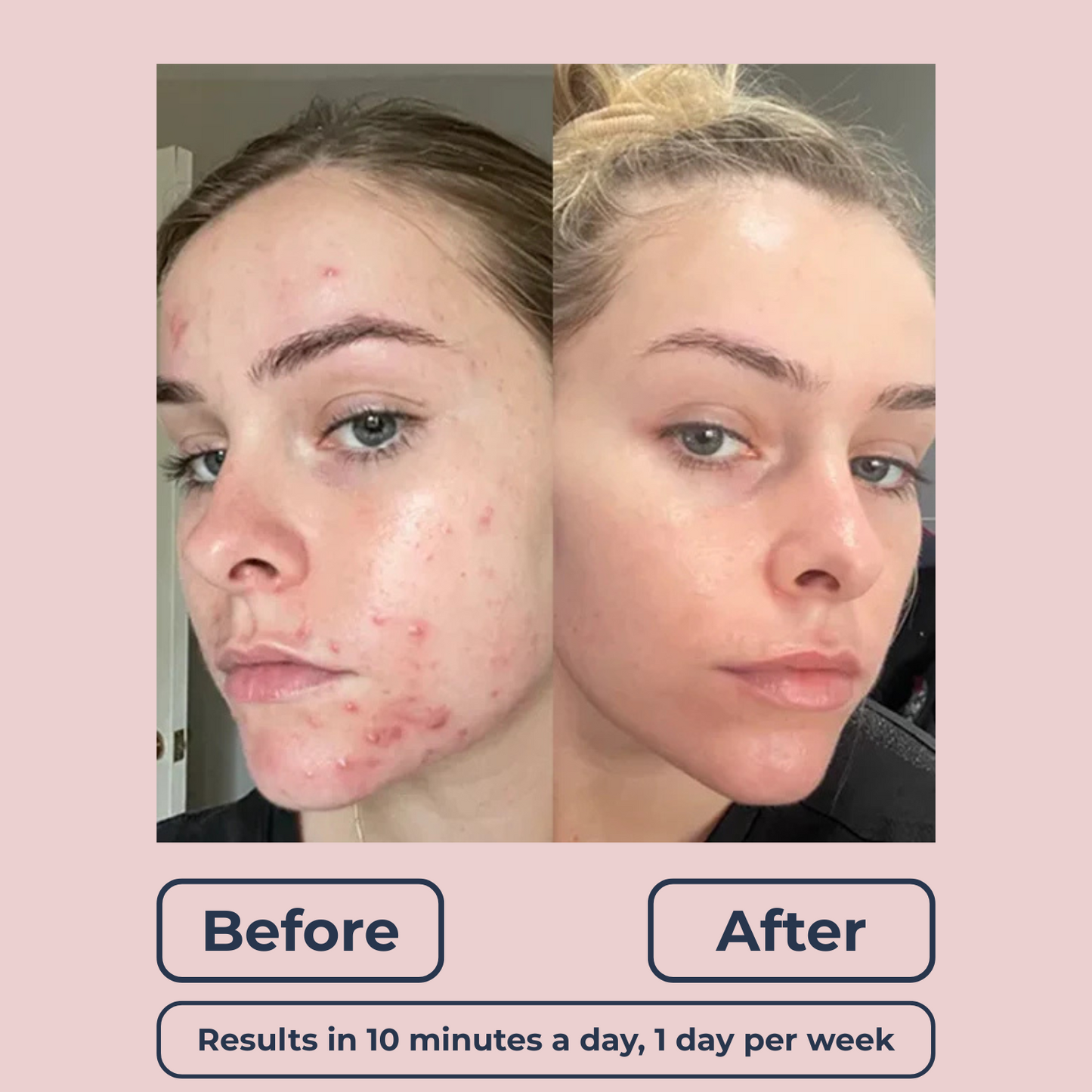 Lutique™ Original 6in1 FaceSculpt